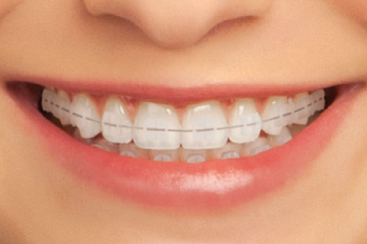 Guide To Teeth Alignment Options To Improve Your Smile
