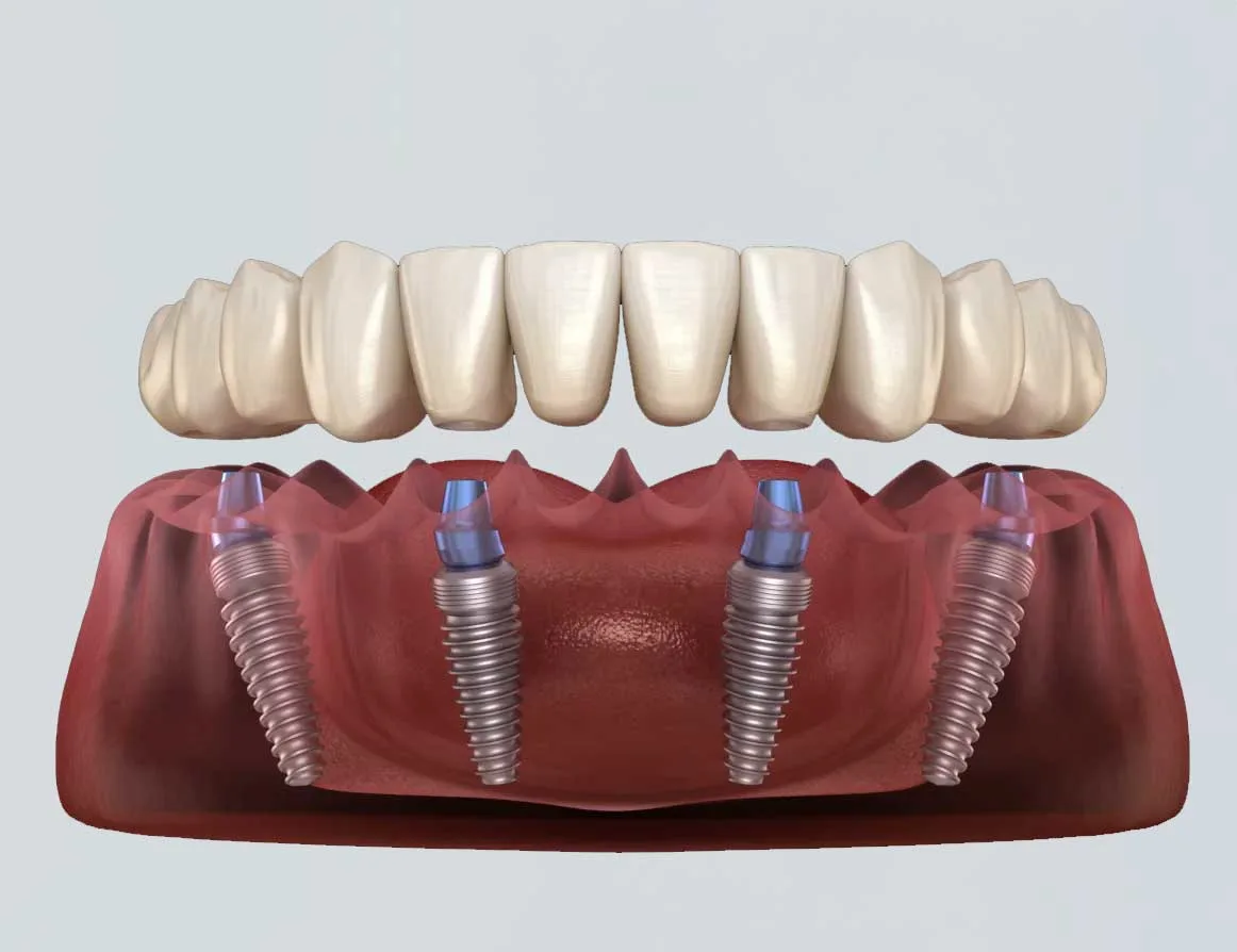 How to Find the Right Full Mouth Restoration Dentist in Agoura Hills