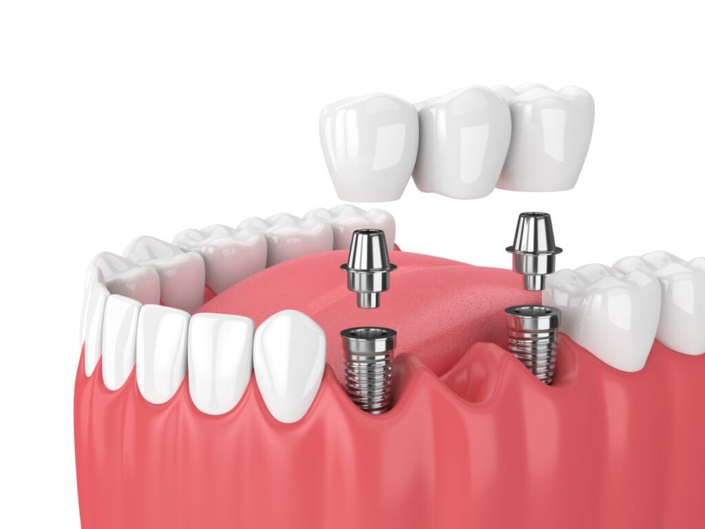 Implants dentist in Agoura Hills